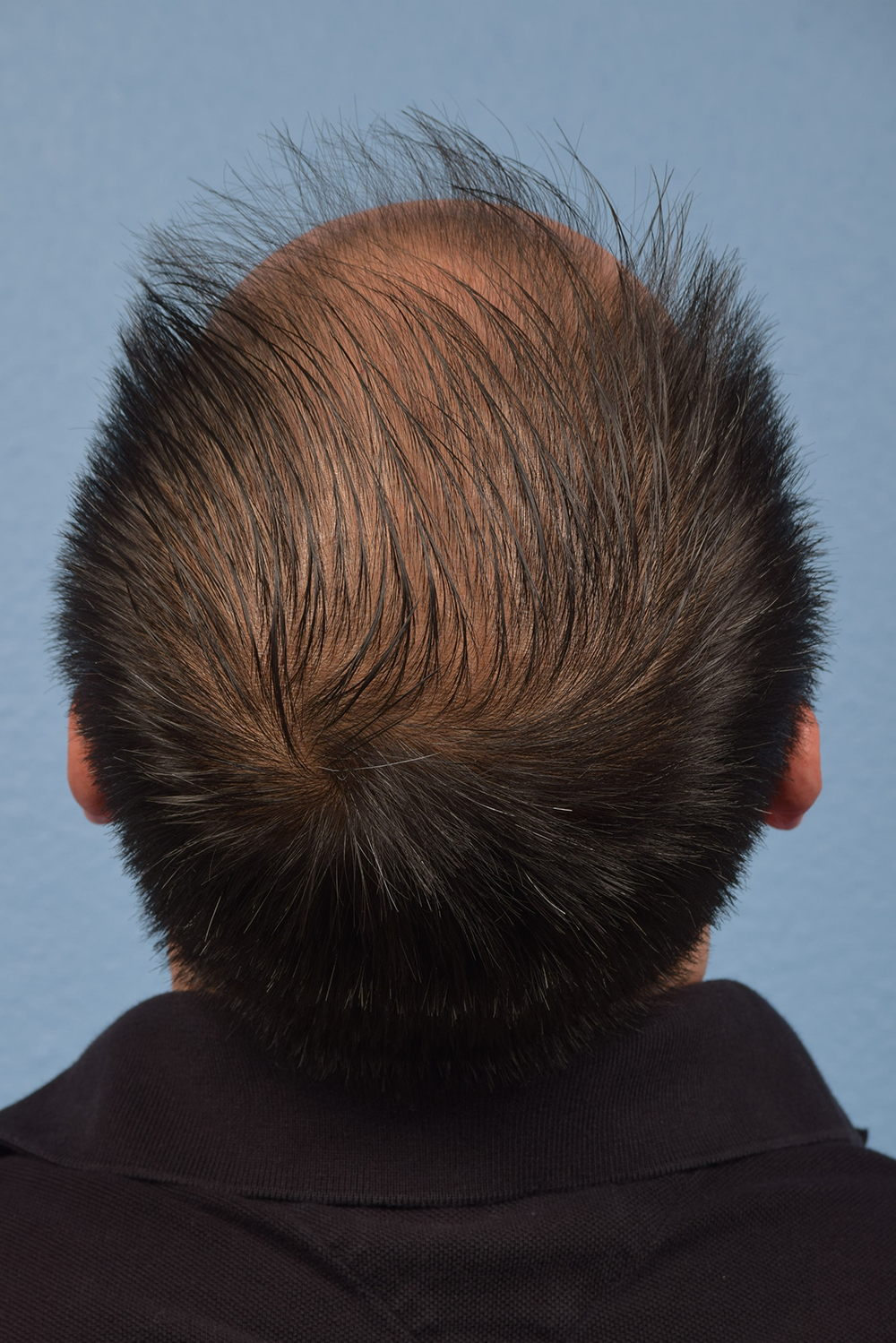 Hair Transplant With Neograft Before and After | Cheng Plastic Surgery
