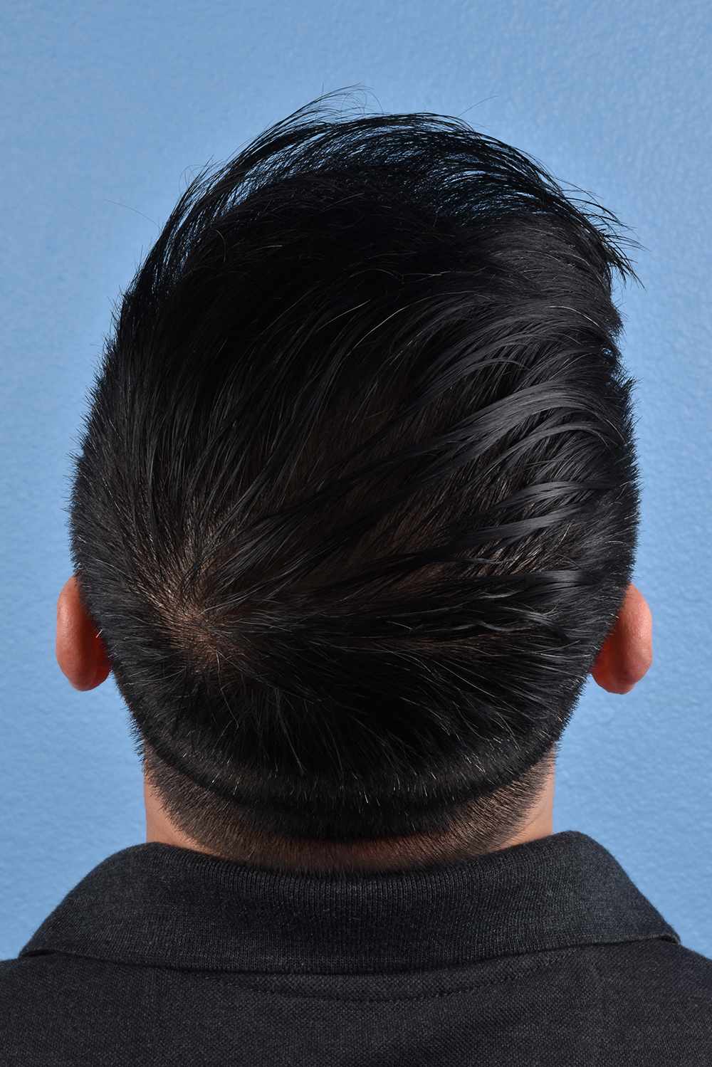 Hair Transplant With Neograft Before and After | Cheng Plastic Surgery