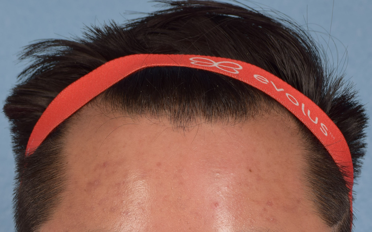 Hair Transplant With Neograft Before and After | Cheng Plastic Surgery