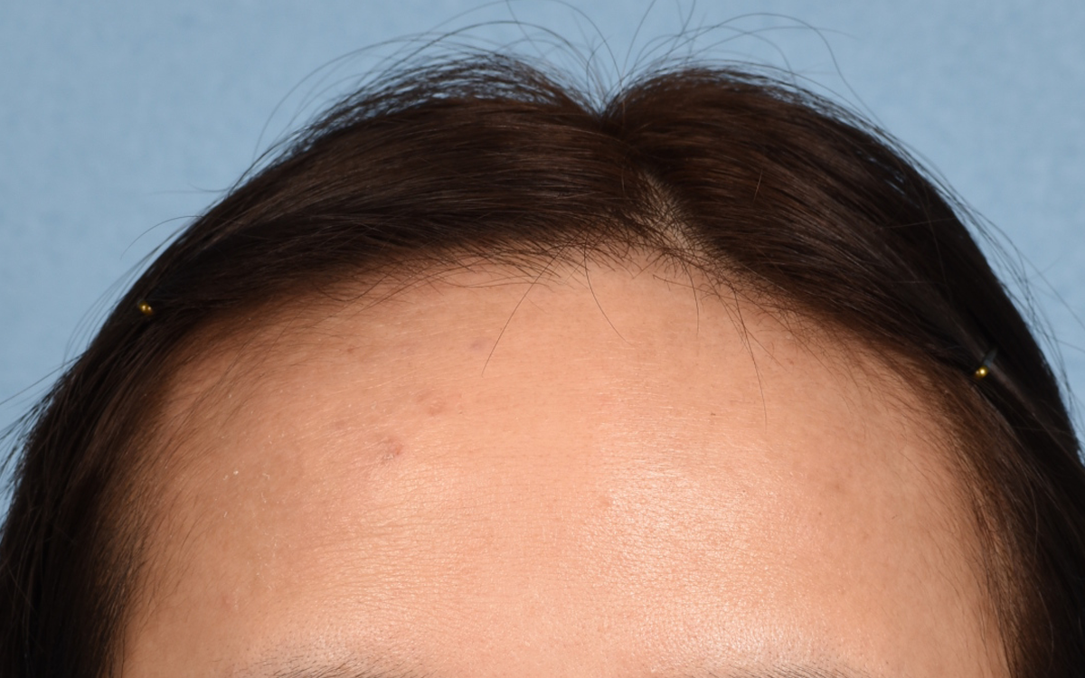 Hair Transplant With Neograft Before and After | Cheng Plastic Surgery