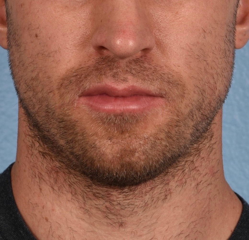 Hair Transplant With Neograft Before and After | Cheng Plastic Surgery