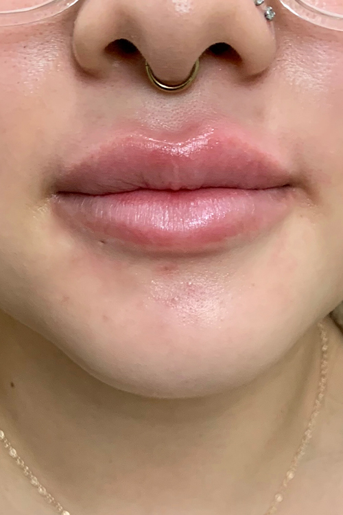 Lip Fillers Before and After | Cheng Plastic Surgery