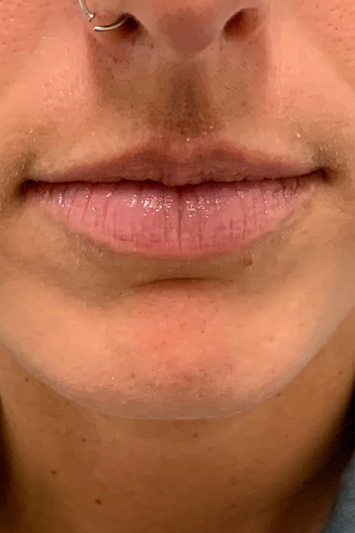 Lip Fillers Before and After | Cheng Plastic Surgery