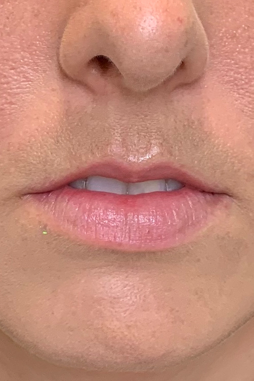 Lip Fillers Before and After | Cheng Plastic Surgery