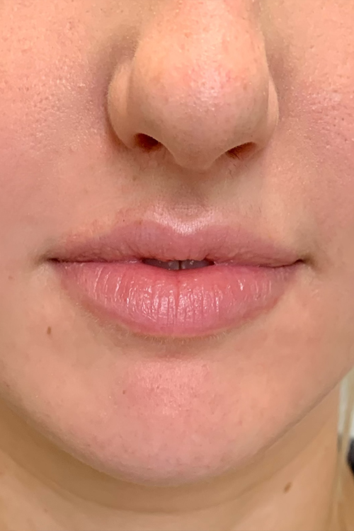Lip Fillers Before and After | Cheng Plastic Surgery