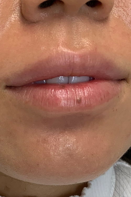 Lip Fillers Before and After | Cheng Plastic Surgery