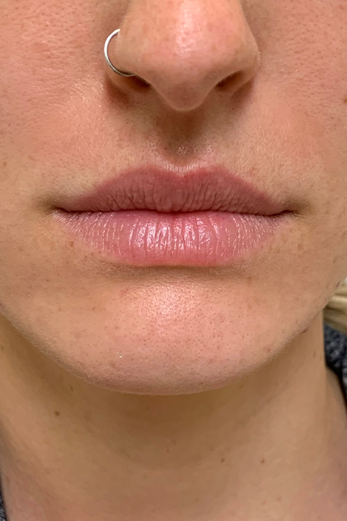 Lip Fillers Before and After | Cheng Plastic Surgery