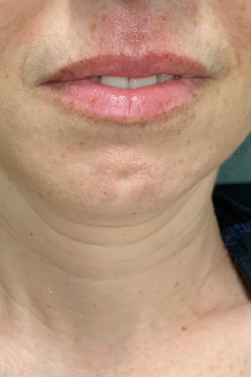Lip Fillers Before and After | Cheng Plastic Surgery