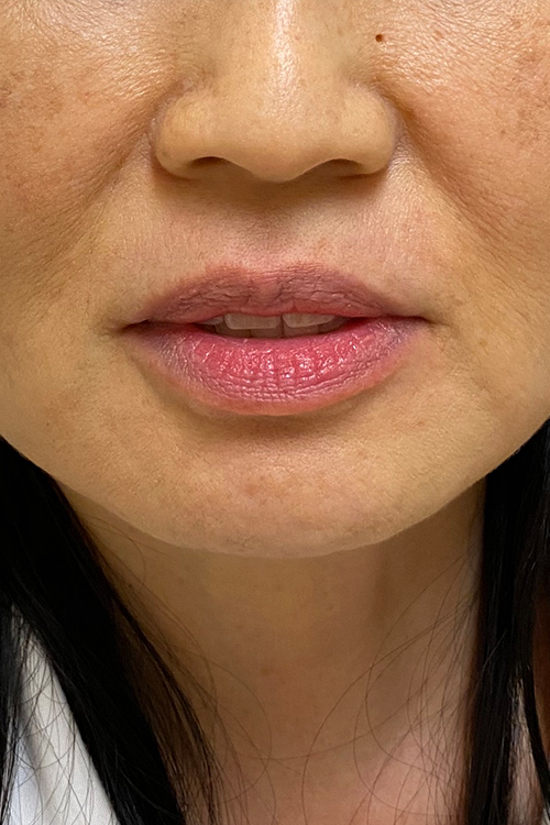 Lip Fillers Before and After | Cheng Plastic Surgery