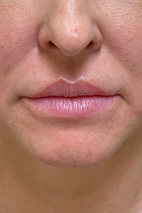 Lip Fillers Before and After | Cheng Plastic Surgery