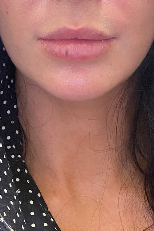 Lip Fillers Before and After | Cheng Plastic Surgery