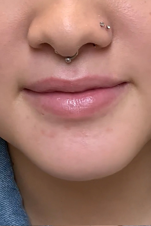 Lip Fillers Before and After | Cheng Plastic Surgery