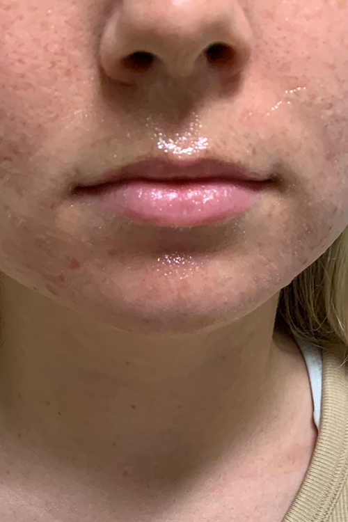 Lip Fillers Before and After | Cheng Plastic Surgery