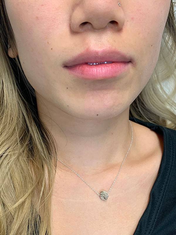Lip Fillers Before and After | Cheng Plastic Surgery