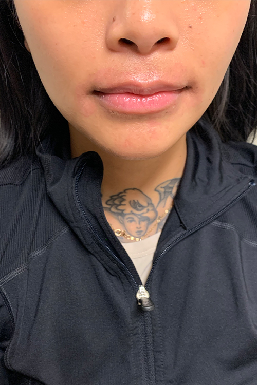 Lip Fillers Before and After | Cheng Plastic Surgery
