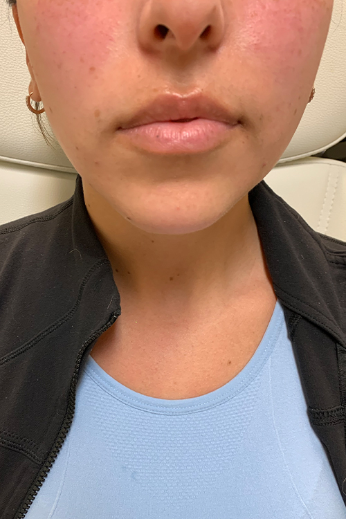 Lip Fillers Before and After | Cheng Plastic Surgery