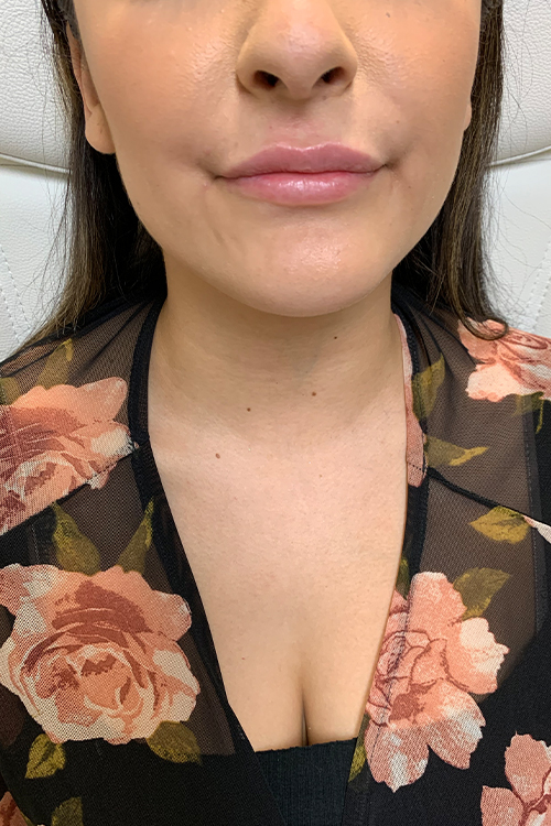 Lip Fillers Before and After | Cheng Plastic Surgery