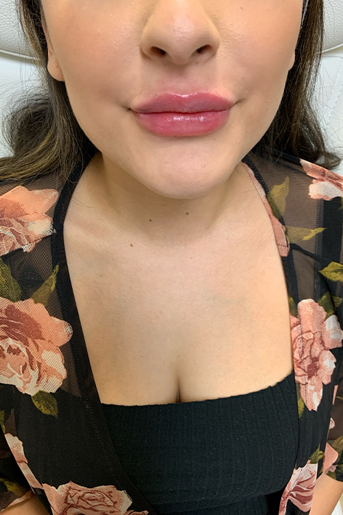 Lip Fillers Before and After | Cheng Plastic Surgery