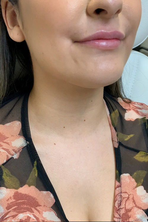 Lip Fillers Before and After | Cheng Plastic Surgery