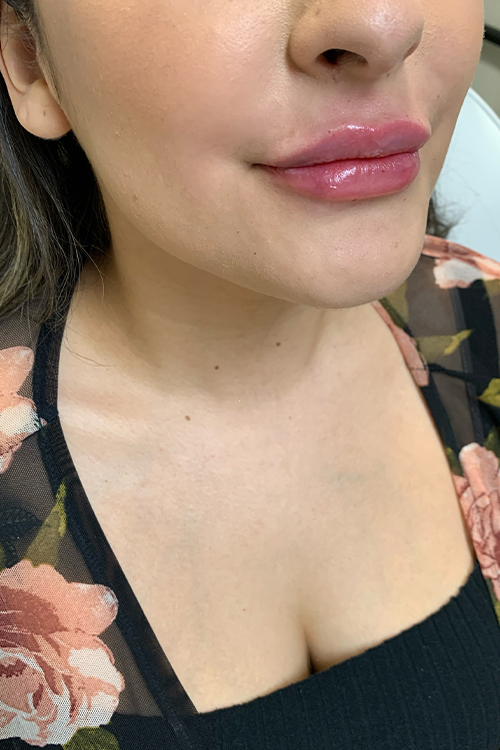 Lip Fillers Before and After | Cheng Plastic Surgery