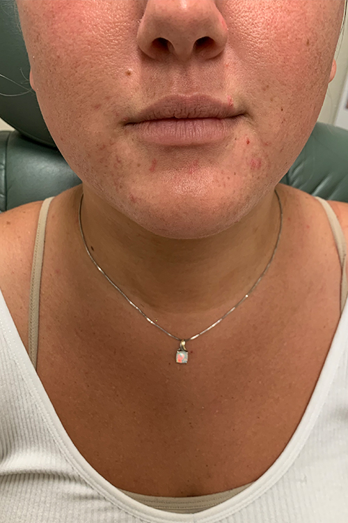 Lip Fillers Before and After | Cheng Plastic Surgery
