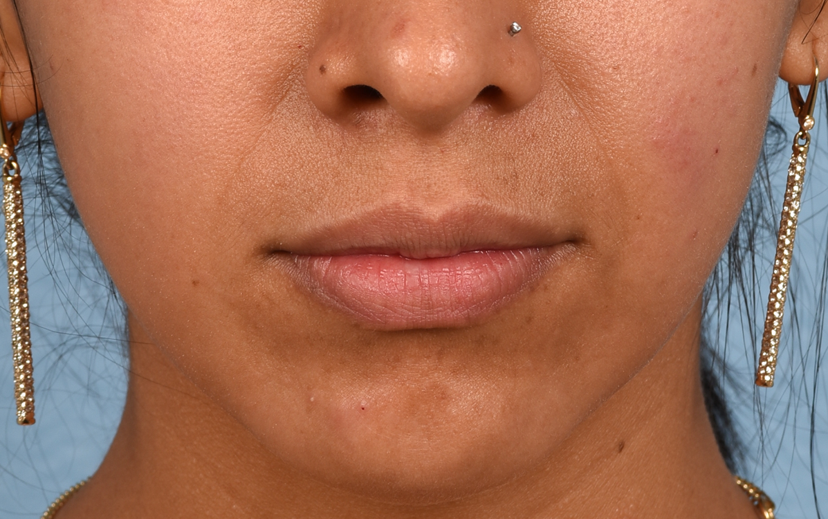 Lip Fillers Before and After | Cheng Plastic Surgery