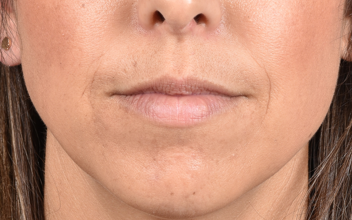 Lip Fillers Before and After | Cheng Plastic Surgery