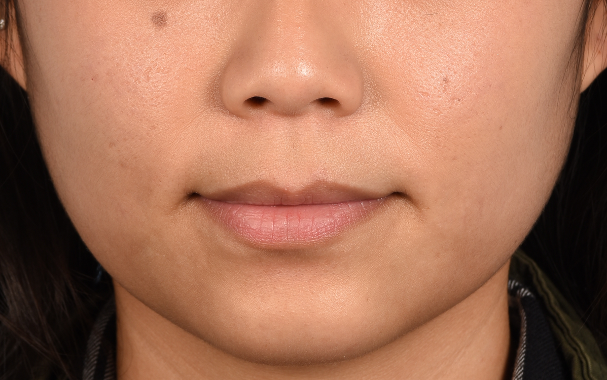 Lip Fillers Before and After | Cheng Plastic Surgery