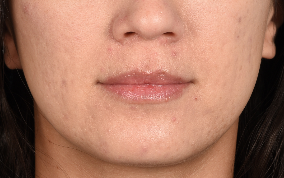 Lip Fillers Before and After | Cheng Plastic Surgery