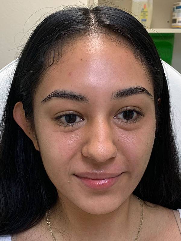 Lip Fillers Before and After | Cheng Plastic Surgery