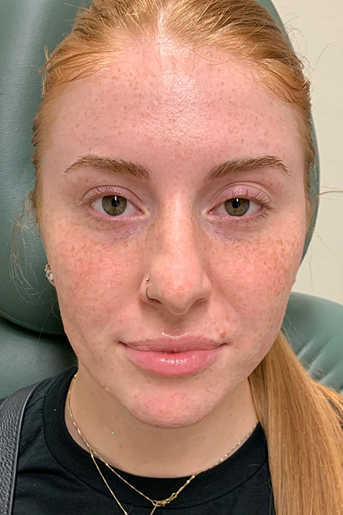 Lip Fillers Before and After | Cheng Plastic Surgery