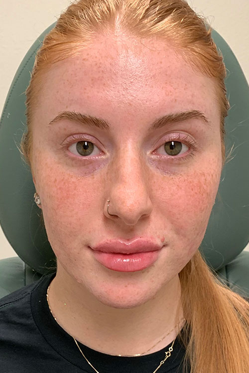 Lip Fillers Before and After | Cheng Plastic Surgery