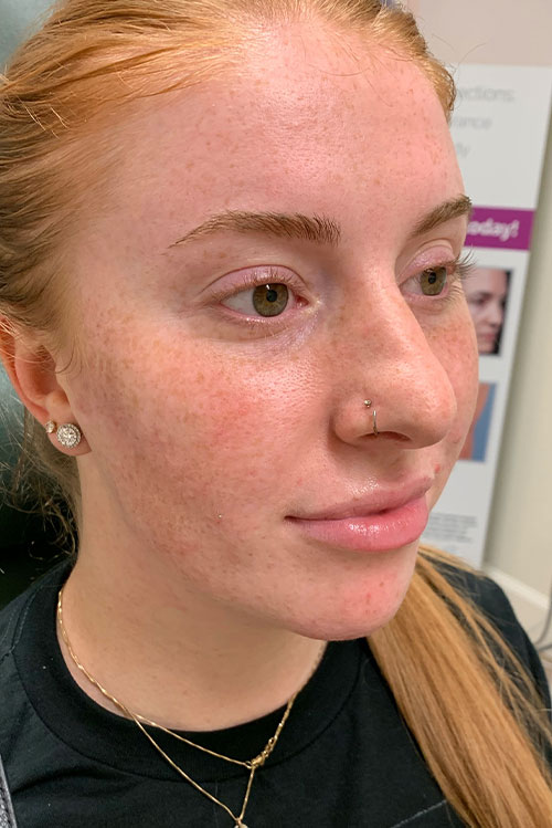 Lip Fillers Before and After | Cheng Plastic Surgery
