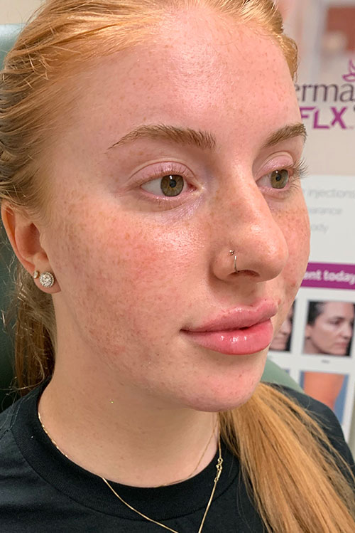 Lip Fillers Before and After | Cheng Plastic Surgery