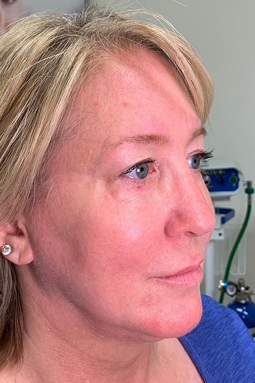 Lip Fillers Before and After | Cheng Plastic Surgery