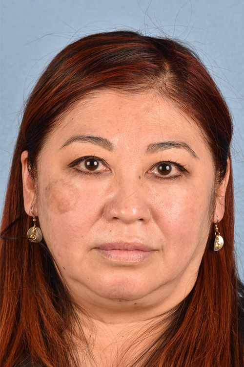 Piqo4 Laser Before and After | Cheng Plastic Surgery