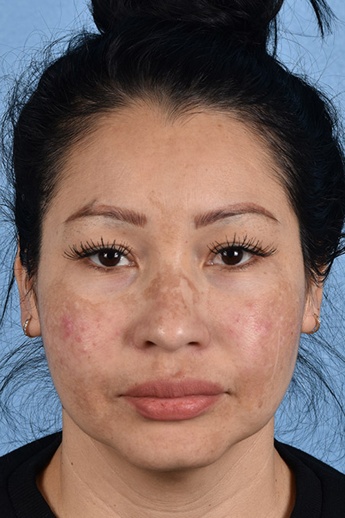 Piqo4 Laser Before and After | Cheng Plastic Surgery