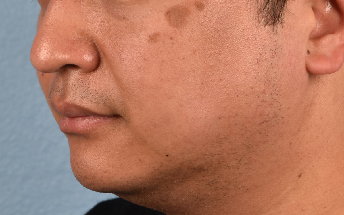 Piqo4 Laser Before and After | Cheng Plastic Surgery