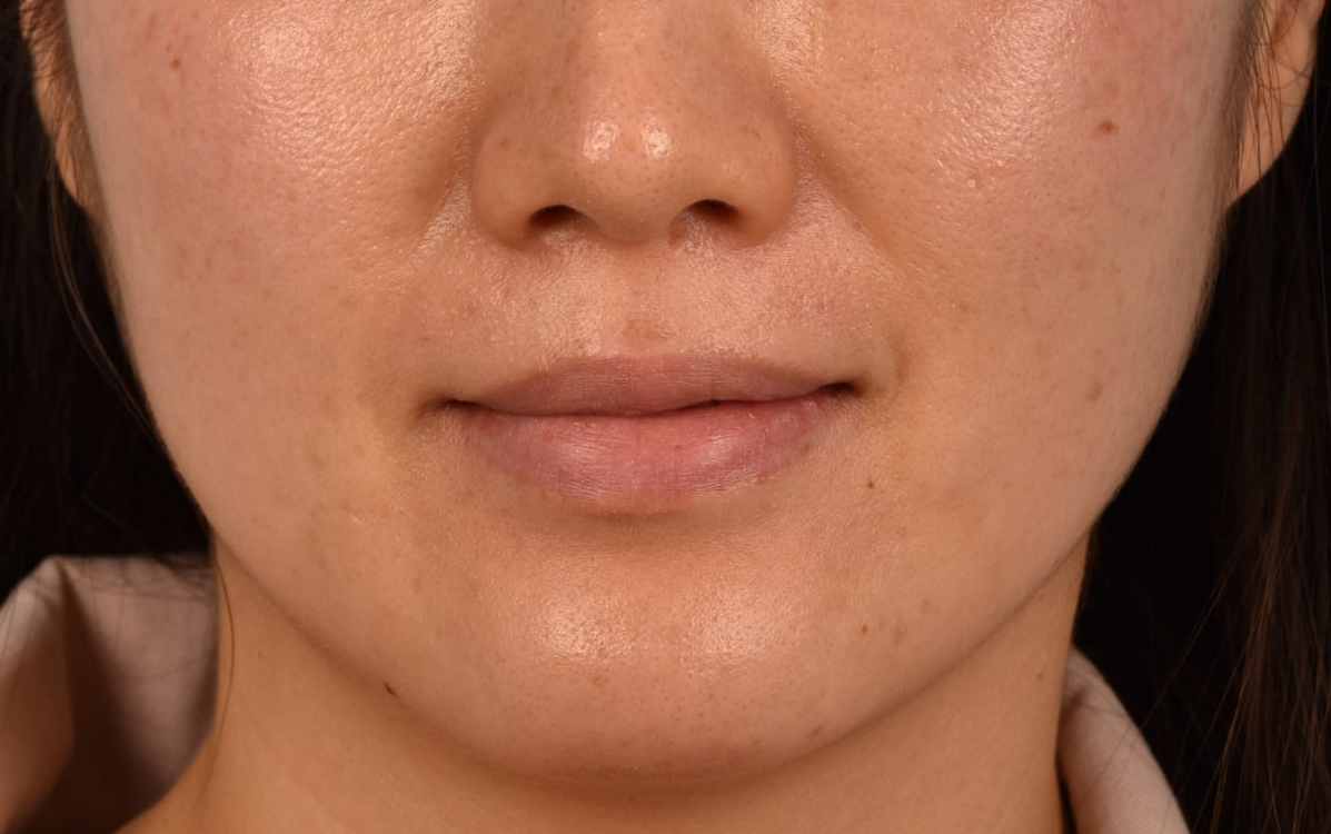 Piqo4 Laser Before and After | Cheng Plastic Surgery