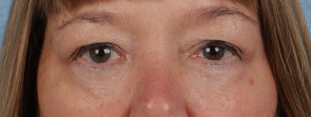 Piqo4 Laser Before and After | Cheng Plastic Surgery