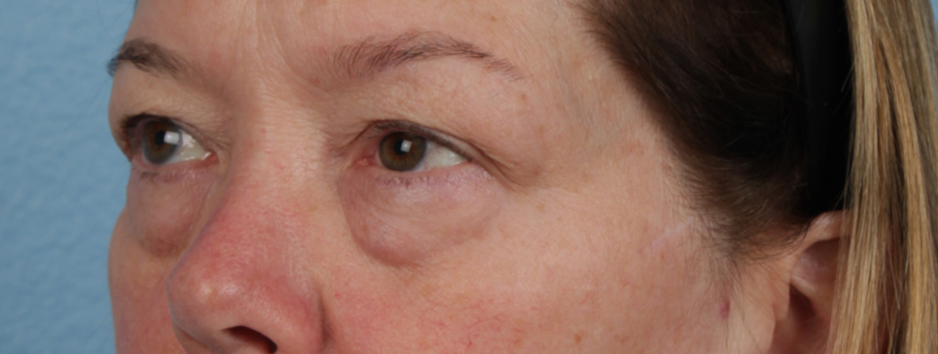 Piqo4 Laser Before and After | Cheng Plastic Surgery