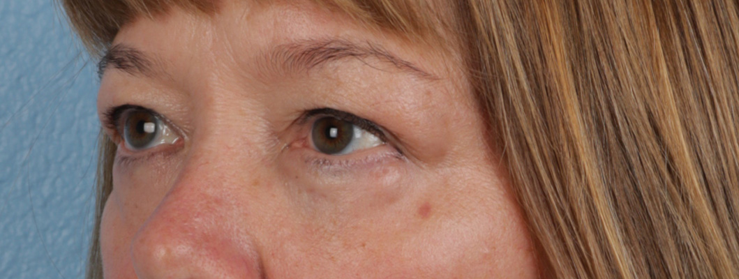 Piqo4 Laser Before and After | Cheng Plastic Surgery
