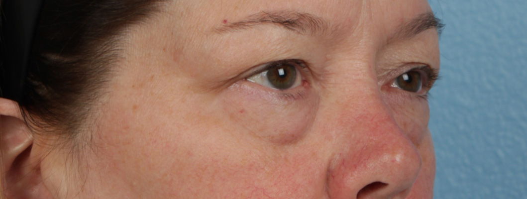 Piqo4 Laser Before and After | Cheng Plastic Surgery