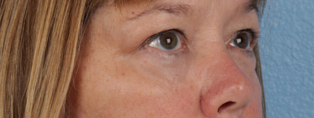 Piqo4 Laser Before and After | Cheng Plastic Surgery